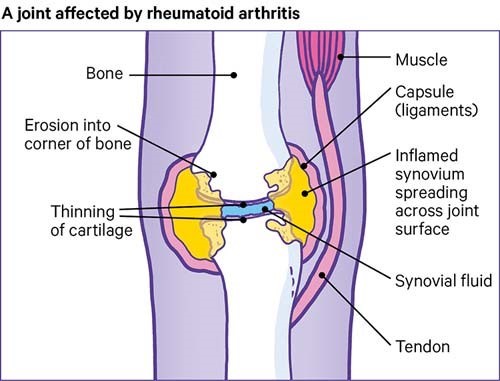 HBOT-in-Arthritis